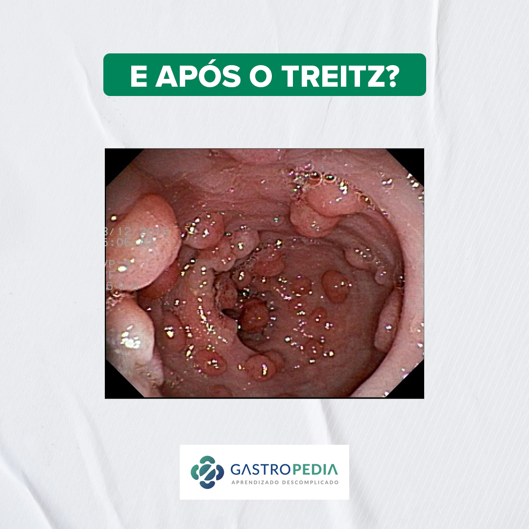 ESTÔMAGO E DUODENO NAS SÍNDROMES DE POLIPOSE - Gastropedia