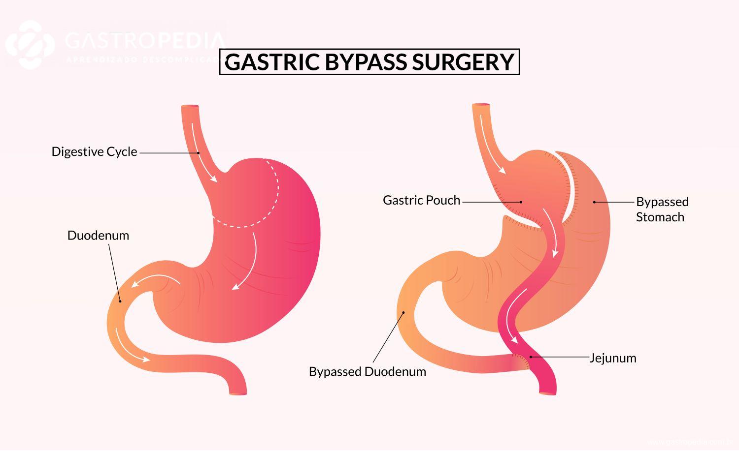 cirurgia de bypass gástrico