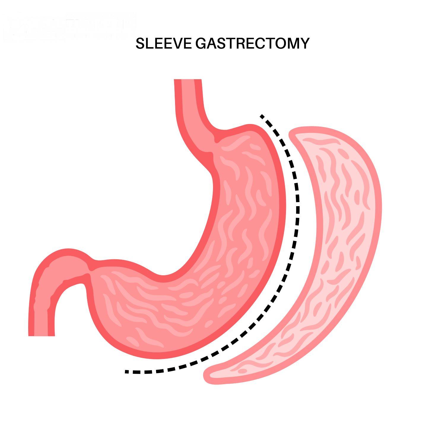 vertical sleeve gastrectomy