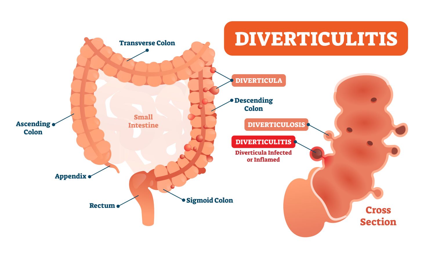 diverticulite